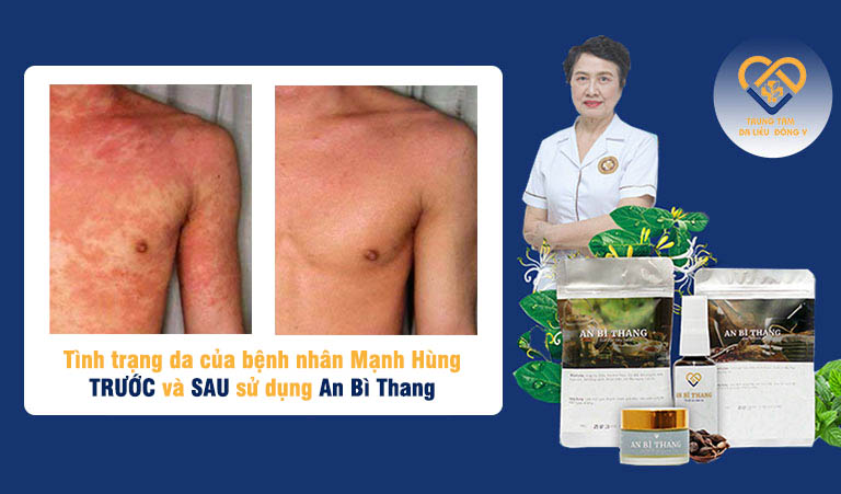 Hình ảnh da của bệnh nhân Mạnh Hùng sau khi điều trị viêm da cơ địa bằng bài thuốc An Bì Thang