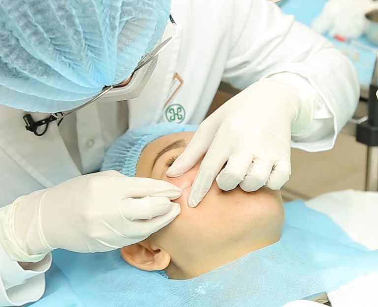 Các bác sĩ sử dụng một đầu kim để xuyên qua bề mặt da tại miệng vết sẹo rỗ