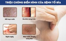 Các triệu chứng của chàm tổ đỉa tuy khó chịu, những phần lớn chỉ ảnh hưởng tới lớp da ở trên cùng (lớp biểu bì)
