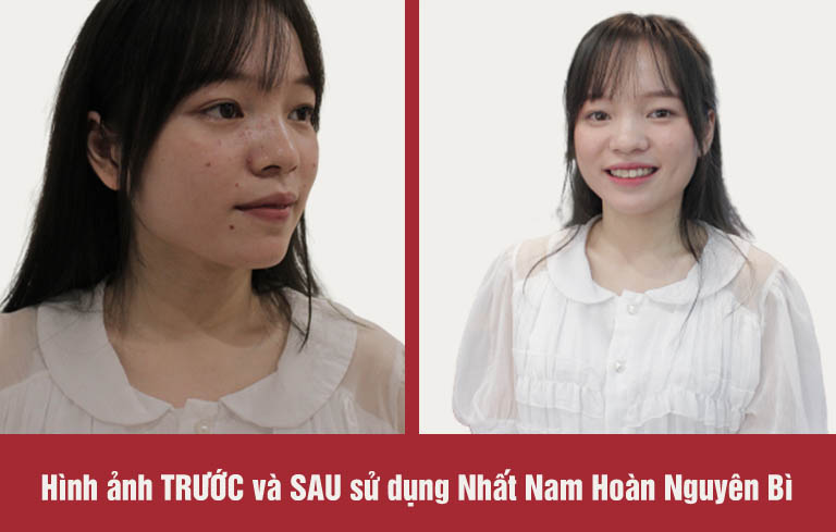 Nhờ sử dụng Hoàn Nguyên và chăm sóc da tại Trung tâm Da liễu Đông y Việt Nam, Linh đã trị mụn thành công trong 3 tháng