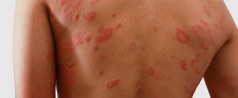 Khi bị chàm, người bệnh sẽ xuất hiện những cơn ngứa ngáy kèm những nốt mụn đỏ hồng trên da