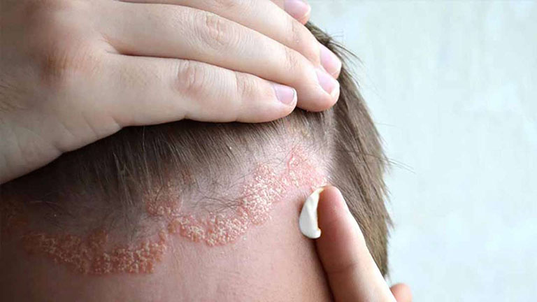 Viêm da tiếp xúc gây tróc vảy ở da đầu