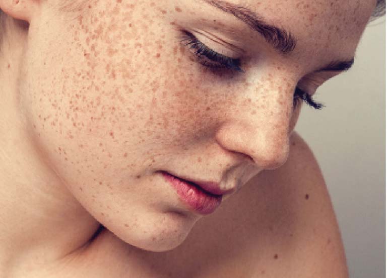 Tình trạng đồi mồi trên da phổ biến ở phụ nữ sau tuổi 40