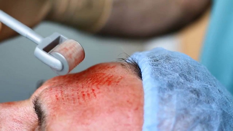 Lăn kim trị sẹo rỗ nếu không xử lý cẩn thận có thể gây ra nhiều ảnh hưởng đến làn da