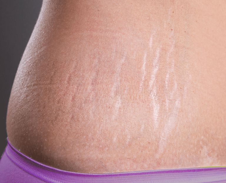 Khắc phục rạn da khi mang thai và sau sinh hiệu quả phụ nữ nên biết