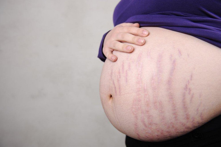 Phụ nữ mang thai là đối tượng dễ bị rạn da nhất