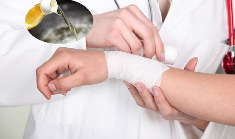 Băng bó và xử lý vết thương tại nhà thật kỹ để tránh hình thành sẹo sau khi bị bỏng