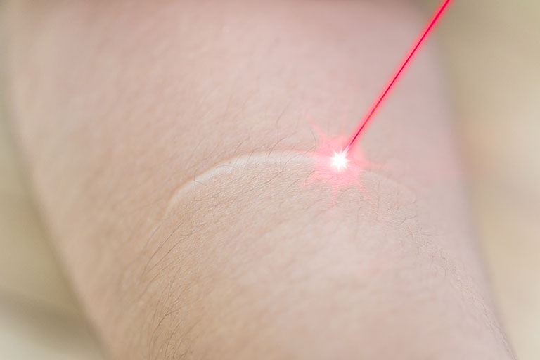 Bệnh viện Bạch Mai có áp dụng công nghệ laser trong điều trị sẹo trắng trên da