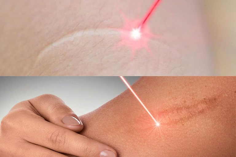 Phương pháp laser xóa sẹo lồi lâu năm