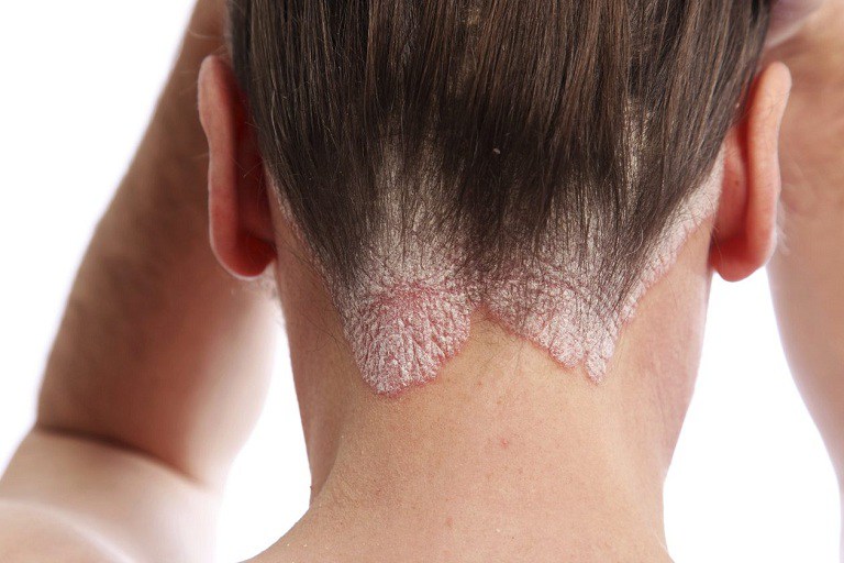 Có rất nhiều cách chữa bệnh á sừng da đầu hiện nay
