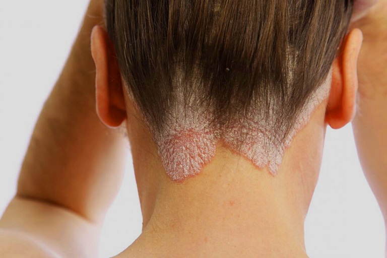 Trong quá trình dùng dầu gội trị vảy nến da đầu, có rất nhiều vấn đề người bệnh cần lưu ý