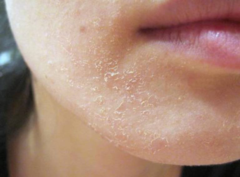 Dấu hiệu của bệnh viêm da tiết bã nhờn trên mặt