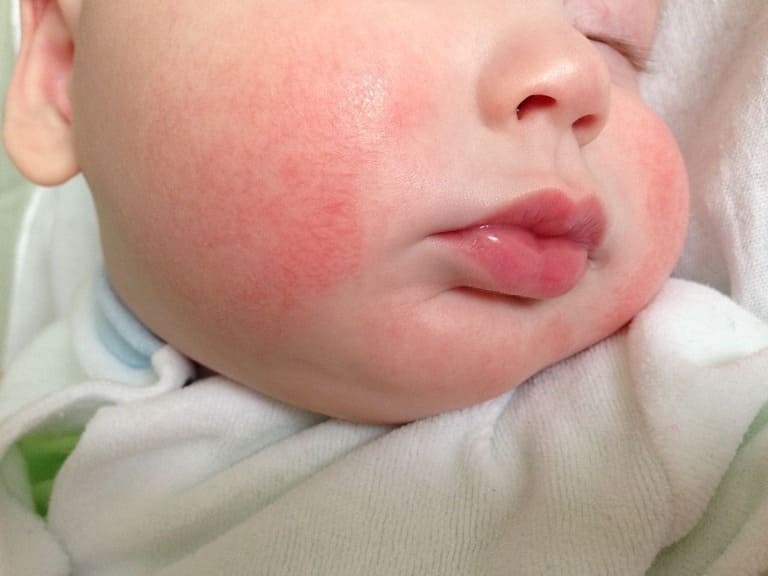 Viêm da ở trẻ sơ sinh là bệnh lý về da khá phổ biến