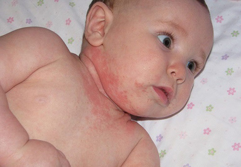 Viêm da ở trẻ sơ sinh - Bệnh viêm da dị ứng