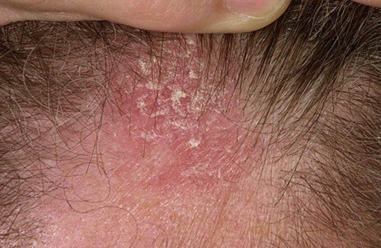 Viêm da tiết bã da đầu là tình trạng khá phổ biến